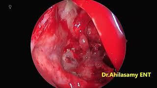 Extensive AFRS invol. Skullbase - Endoscopic management