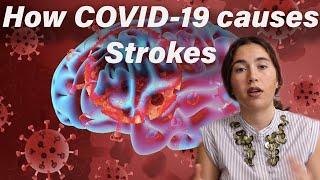 Strokes & Aberrant Coagulation in COVID-19 patients