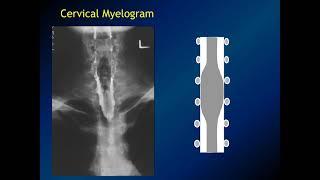 Spinal Neoplasms: Radiologic-Pathologic Correlation