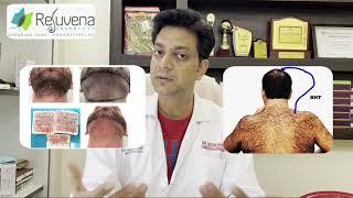 Best Hair Transplant In Jaipur || ट्रांसप्लांट किए हुए बाल कितने साल तक रहते हैं |