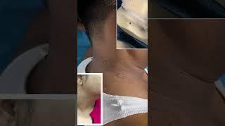 Skin Tag Removal at Skinaa Clinic #viral #shorts #trending