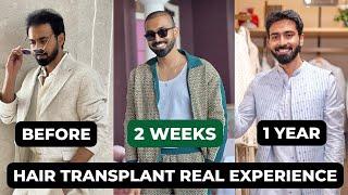 Hair transplantation- After 1 year (Actual Facts)| Hair care tips post surgery| Medicines, hairstyle