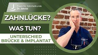 Zahnlücke - Was tun?| Unterschied Brücke und Implantat | Dr. Jahnke