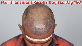 Most Natural Hair Transplant Results in Just 5 Months | DHI Hair Transplant Cost  in India