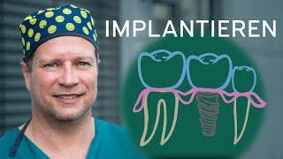 Klassisches Implantat in der Oralchirurgie