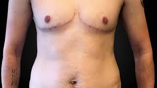 Chest Reconstruction - Female to Male - Before & After Pictures