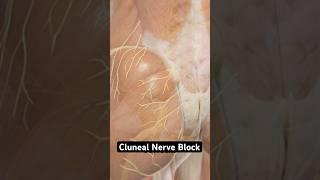Cluneal Nerve Block (3D Animation)