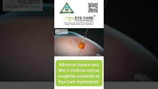 Retina Surgery Doctors in Hyderabad| Dr. Musaab @ Eye care Hyderabad #eyecare #doctor #eyes