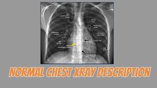 Description OF Normal XRay Chest