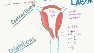 Preterm Labor visual summary.