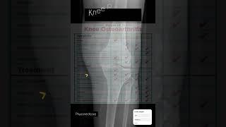 Awareness for knee osteoarthritis #physiotherapy #kneepain #awarenessvideo #youtubeshorts