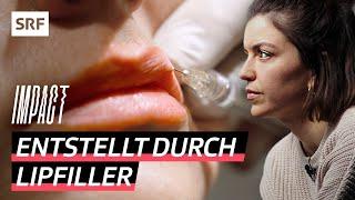 Verpfuschte Lippen – Spritzen Kosmetikstudios illegal Hyaluron? | Impact | SRF