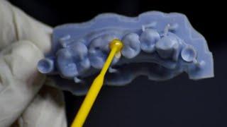 Inlay and Onlay | Metal free Restoration | Digital Dentistry | Smile Galleria