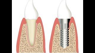 Zirkonimplantate - genau so gut wie Titanimplantate?