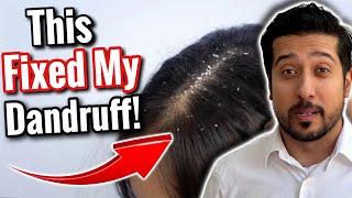 How to Get Rid of Dandruff For GOOD | This WILL Eliminate Dandruff