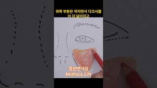 중안면거상 Midfacelift  #엔도타인 #중안면부#팔자주름 #다크서클