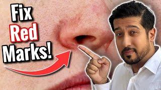 Redness Around Nose | Get Rid of Perioral Dermatitis FAST