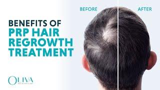 Top 5 Reasons To Choose PRP Hair Loss Treatment