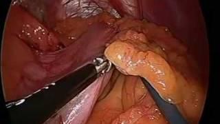 laparoscopic sleeve gastrectomy in Male BMI 44 by Dr Craig Taylor OClinic Sydney