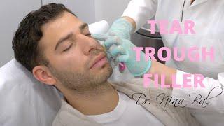 Men Under Eye Filler Before And After  Dr Nina Bal Facial Sculpting | Tear Trough Filler London