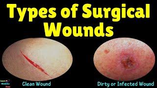 Types of Surgical Wounds | Surgical Wound Classification