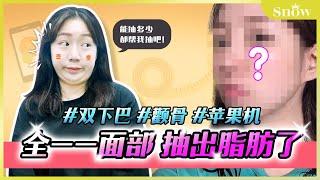 韓國面部吸脂+額頭脂肪填充手術 親自手術的整形vlog 