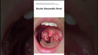 Acute rheumatic fever
