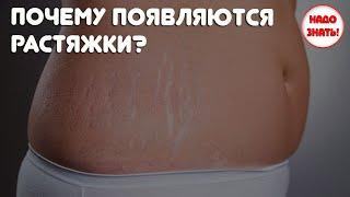 Почему появляются растяжки — основные причины?