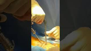 Dual Portal Endoscopic Spine Surgery-Ultra-Minimally Invasive