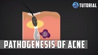 Acne Pathophysiology | Acne Vulgaris (Pimples) Pathogenesis