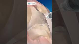 Khô khớp gối gây đau là tình trạng như thế nào? #cơxươngkhớp #khopgoi #chiropractic #shorts