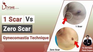 Scarless Technique of Gynecomastia Surgery | 1 Scar Vs Zero Scar | Best Plastic Surgeon in India