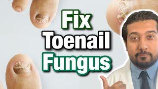 How to Treat Toenail Fungus CORRECTLY | Easy Steps (2021)