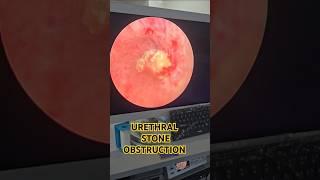 retention of urine by urethral stone #retentionurine #urethra #stone