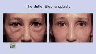 Revolutionizing Eyelid Surgery: Discover Dr. Scheiner’s Breakthrough Better Blepharoplasty