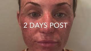 DOT LASER SKIN RESURFACING: RECOVERY