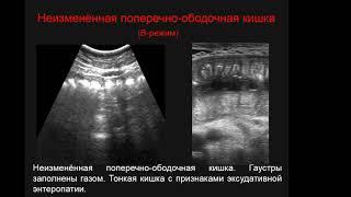 Латышева А.Я. «Роль УД  неспецифического язвенного колита и болезни Крона»