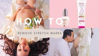 My recommended routine to remove stretch marks | Mama’s Choice Stretch Mark Treatment series