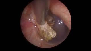 825 - Cholesteatoma Ear Wax Removal