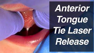 Anterior Tongue Tie Laser Release