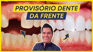 Prótese Provisória de um Dente da Frente: Como Funciona? (Passo a Passo)