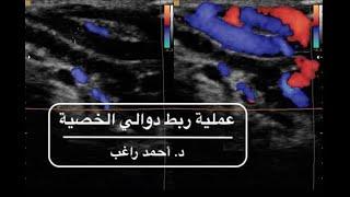 أمراض ذكورة - علاج دوالى الخصية الحقيقي