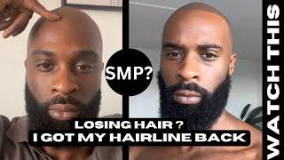 BEFORE U GET HAIR TRANSPLANT WATCH THIS!