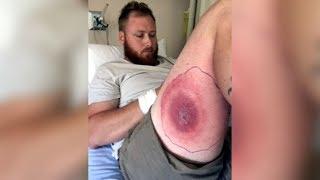 N.S. man recovering from suspected brown recluse spider bite