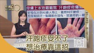 汗皰疹？香港腳？ 教你一秒分辨【聚焦2.0】第347集