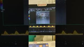 triphasic flow artery