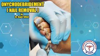 Simple Onychodebridement (Removal of Toe Nail) With Dr. Roger Kilfoil! | Podiatry Explained