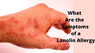 What Are the Symptoms of a Lanolin Allergy