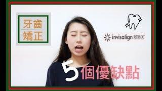 【牙套】Invisalign隱適美牙套的五個優缺點 || Samantha