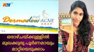 Best solution for Pimples and pimples marks#dermadew acne soap review in malayalam#